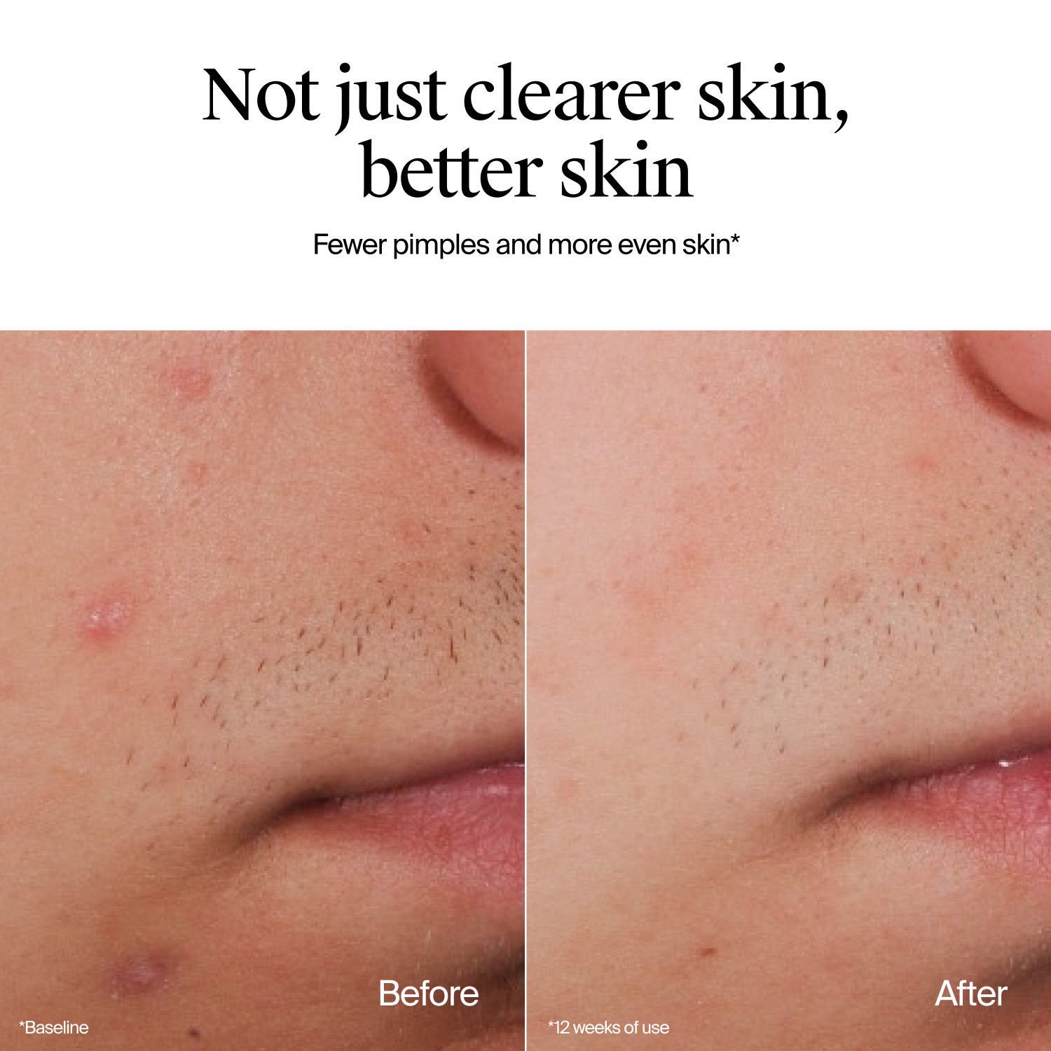 slide 4 of 7, Neutrogena Oil Free Acne Wash, Fragrance Free 9.1Oz, 9.1 oz