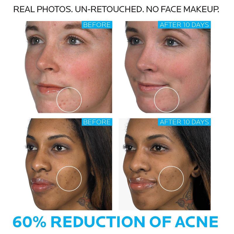 slide 4 of 7, La Roche Posay Effaclar Duo Acne Treatment with Benzoyl Peroxide, Dual Action Acne Spot Treatment - 1.35 fl oz​, 1.35 fl oz