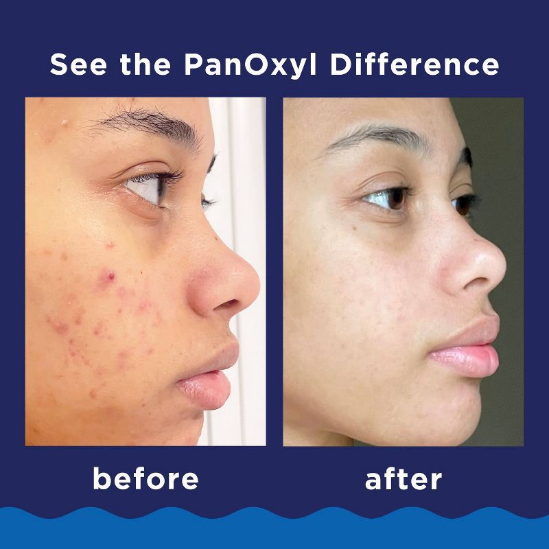 slide 6 of 9, PanOxyl 10% Benzoyl Peroxide Acne Foaming Wash - 5.5oz, 5.5 oz