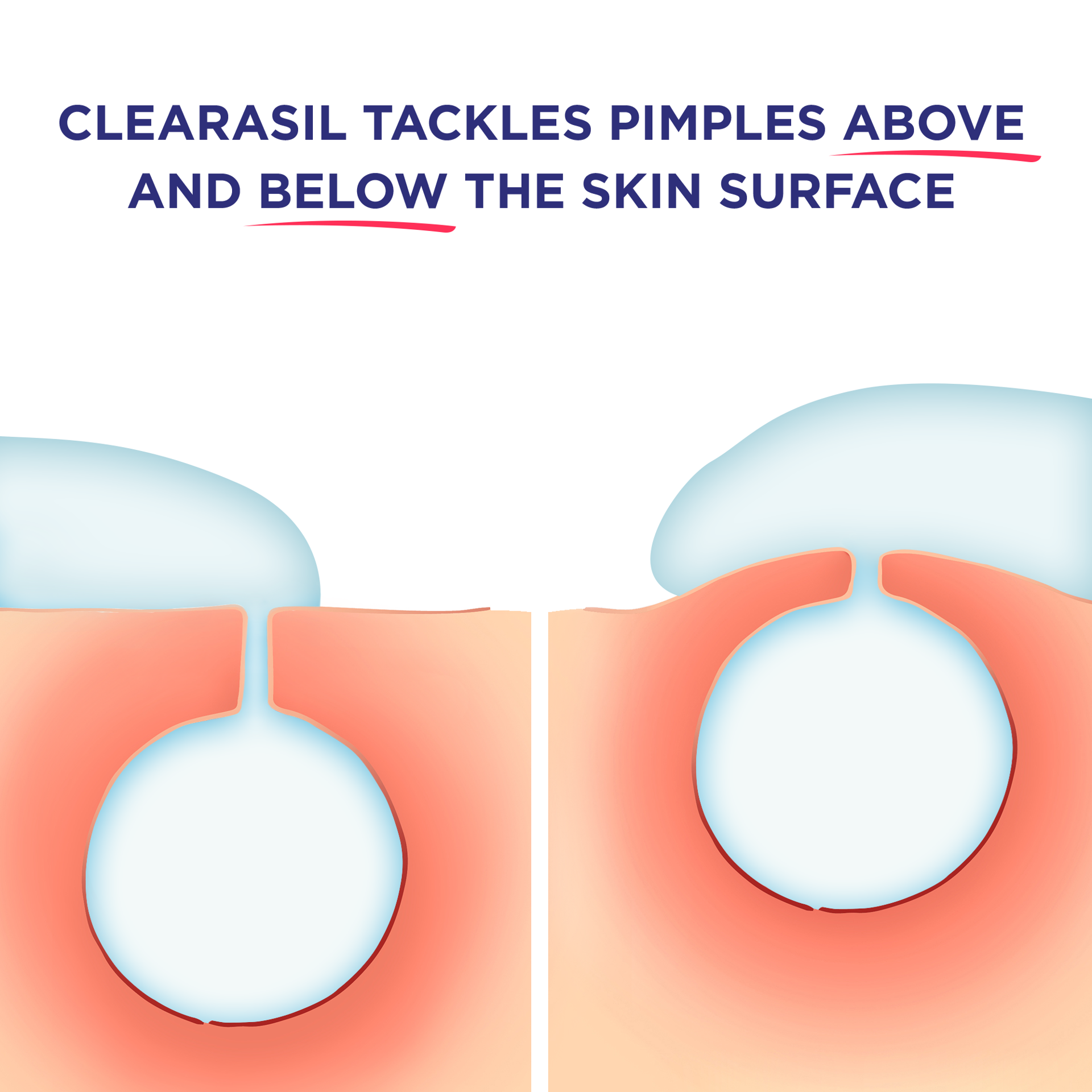 slide 3 of 5, Clearasil Ultra Rapid Action Medicated Acne Pads, 90 ct