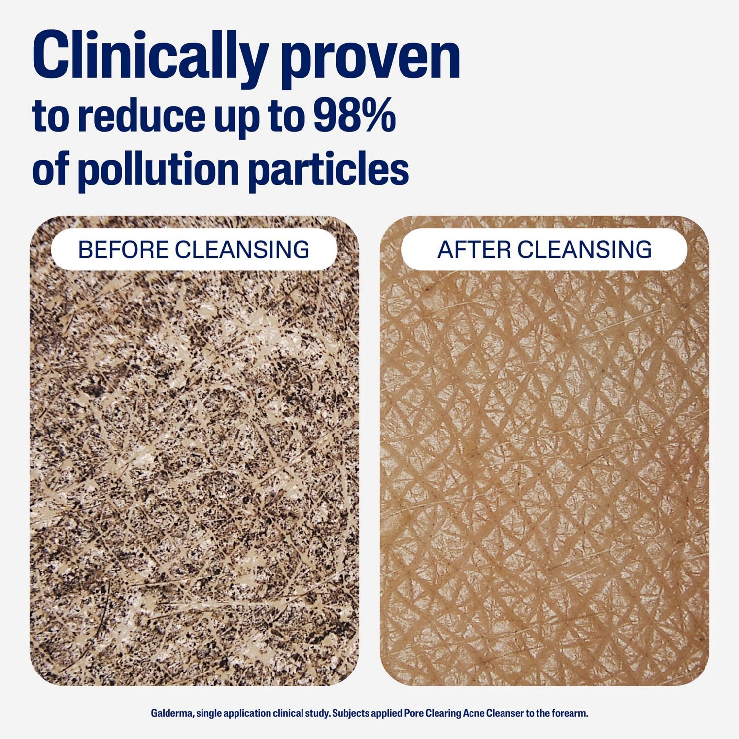 slide 6 of 9, Cetaphil Gentle Clear Pore Clearing Acne Cleanser with 2% Salicylic Acid, 8 fl oz