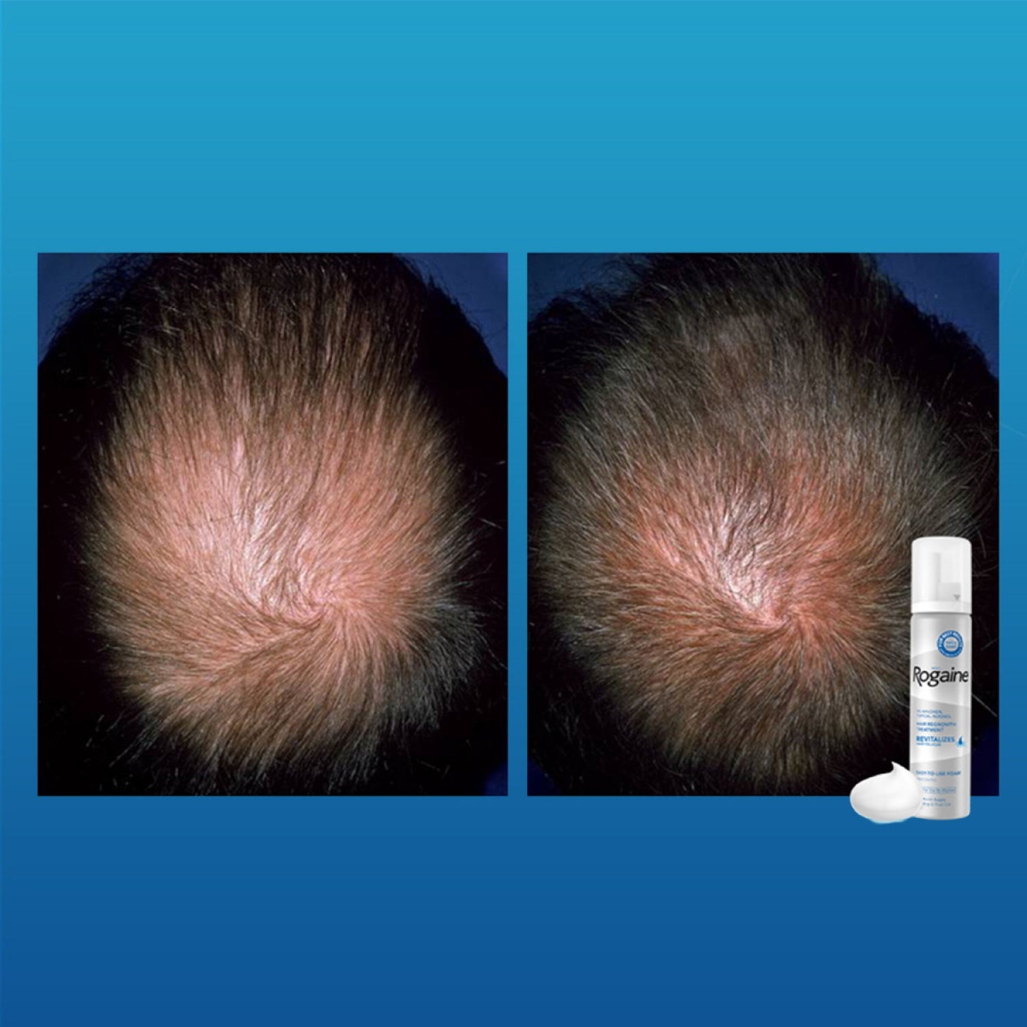 slide 5 of 8, Rogaine Men's Rogaine 5% Minoxidil Topical Foam, One Month Supply, 2.11 ea