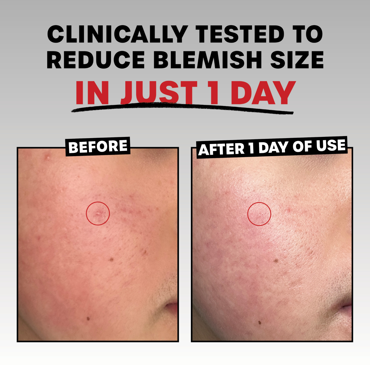 slide 4 of 4, Thayers Rapid Acne Treatment 0.68 fl oz, 0.68 fl oz