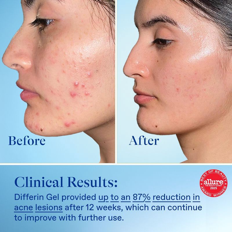 slide 5 of 8, Differin Acne Retinoid Face and Body Treatment Gel Adapalene 0.1% - 15g, 15 gram