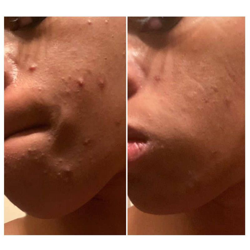 slide 5 of 6, Urban Skin Rx 3-in-1 Clear Skin Cleansing Bar - 2.0oz, 2 oz