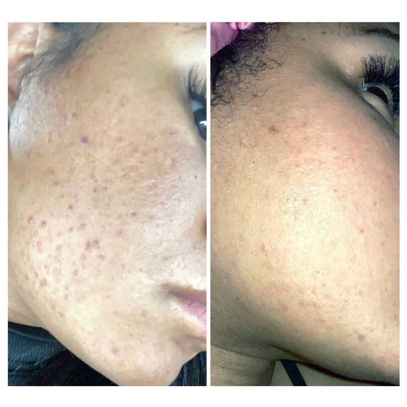 slide 6 of 6, Urban Skin Rx 3-in-1 Clear Skin Cleansing Bar - 2.0oz, 2 oz