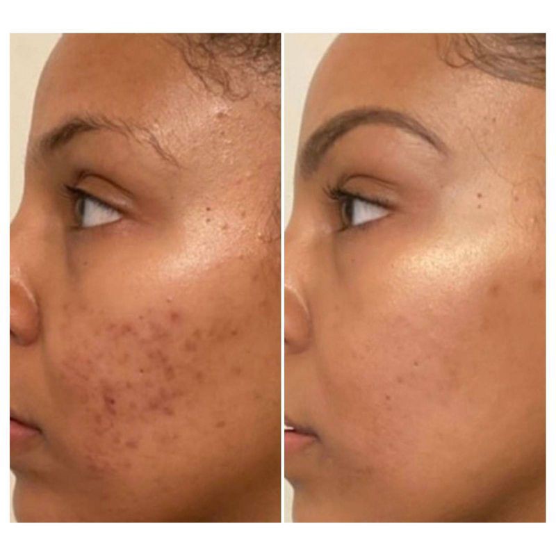 slide 5 of 5, Urban Skin Rx 3-in-1 Even Tone Cleansing Bar - 2.0oz, 2 oz