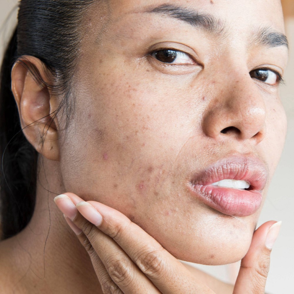 slide 8 of 17, Neutrogena Stubborn Texture Daily Acne Facial Cleanser, Salicylic Acid Face Wash + Glycolic & Polyhydroxy Acids, Fragrance-Free, 6.3 fl. oz, 6.3 fl oz