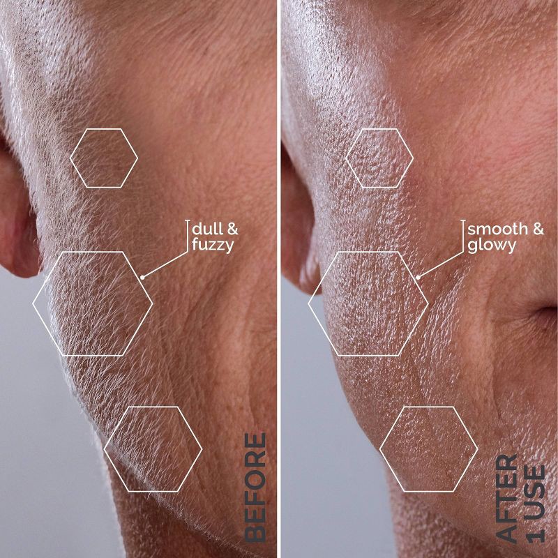 slide 5 of 12, Spa Sciences SIMA Deluxe Sonic Dermaplaning Tool for Exfoliation & Peach Fuzz Removal, 1 ct