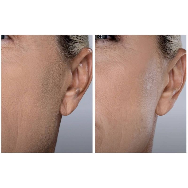 slide 7 of 12, Spa Sciences SIMA Deluxe Sonic Dermaplaning Tool for Exfoliation & Peach Fuzz Removal, 1 ct