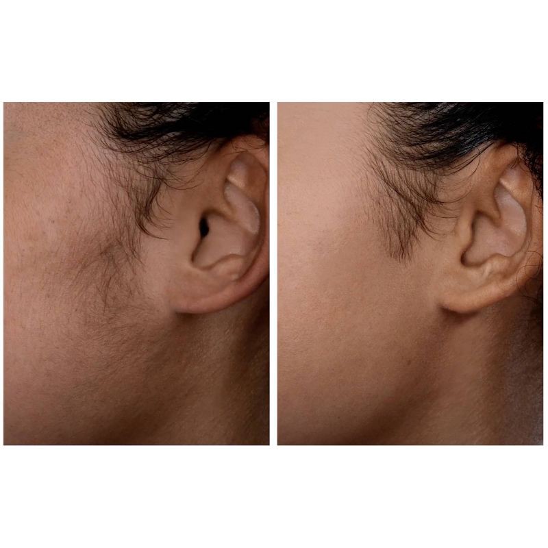 slide 10 of 12, Spa Sciences SIMA Deluxe Sonic Dermaplaning Tool for Exfoliation & Peach Fuzz Removal, 1 ct