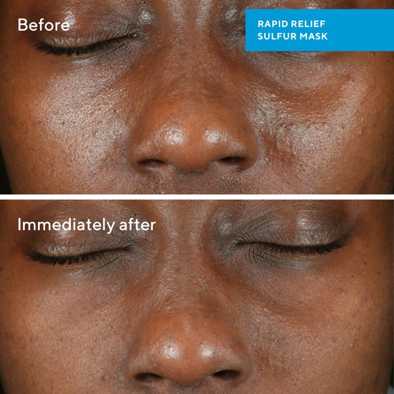 slide 3 of 6, Murad Rapid Relief Acne Sulfur Clay Mask with Salicylic Acid 2.5 oz / 74 ml,