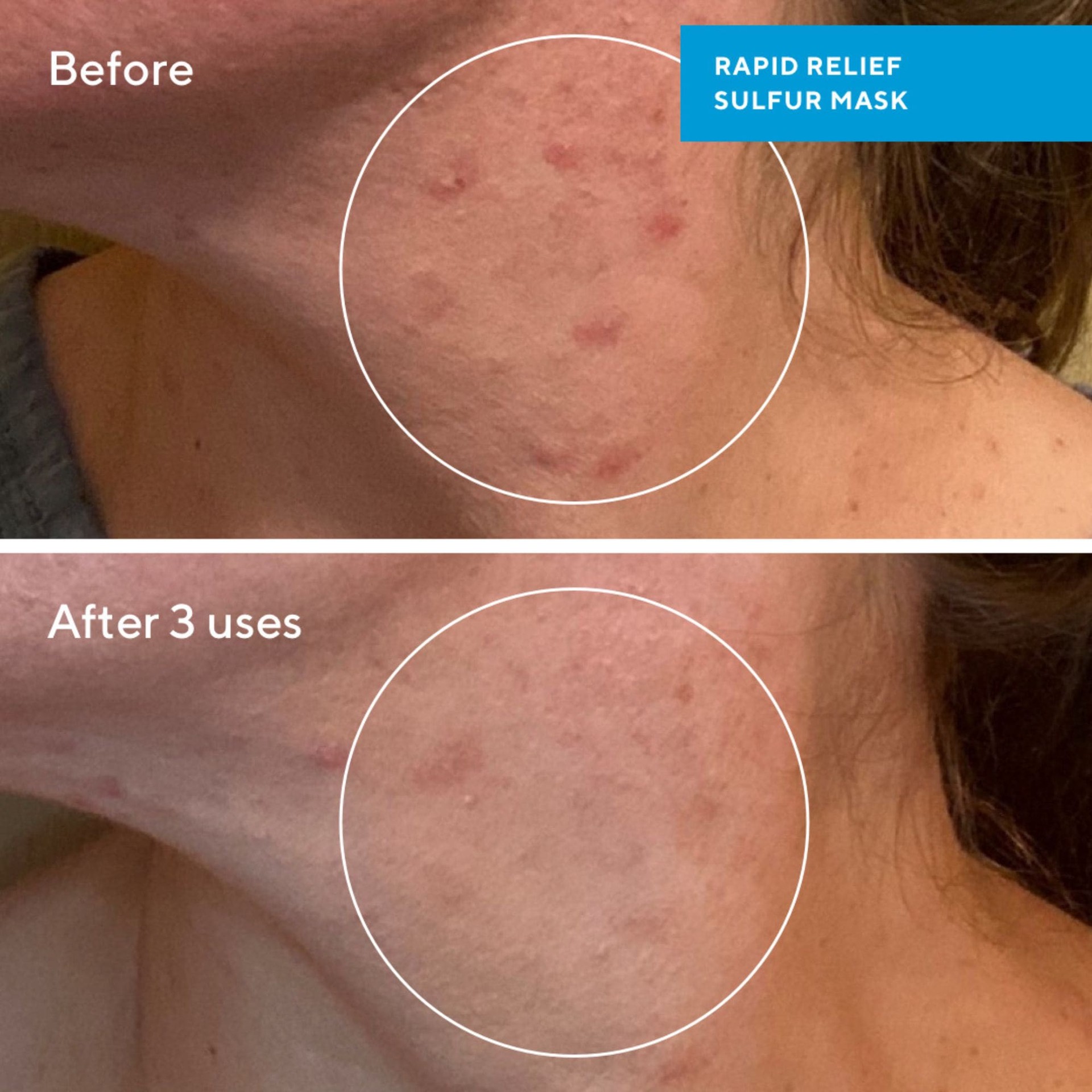 slide 4 of 6, Murad Rapid Relief Acne Sulfur Clay Mask with Salicylic Acid 2.5 oz / 74 ml,