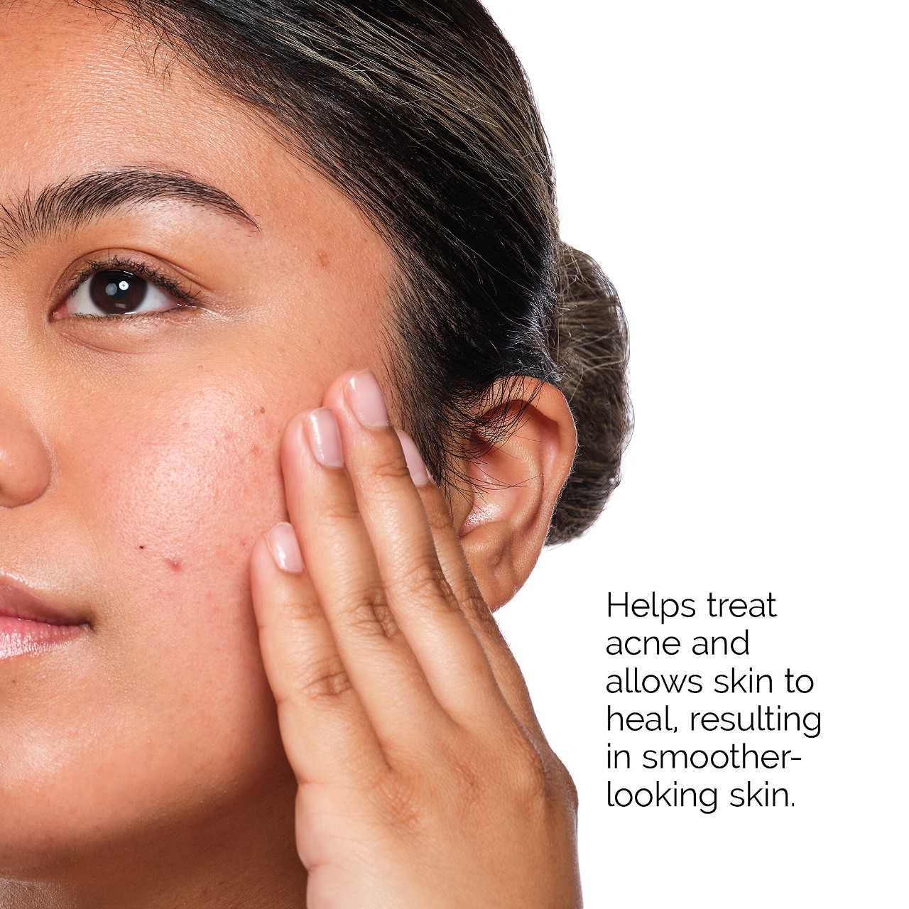 slide 3 of 5, The Ordinary The Acne Set with Salicylic Acid, 