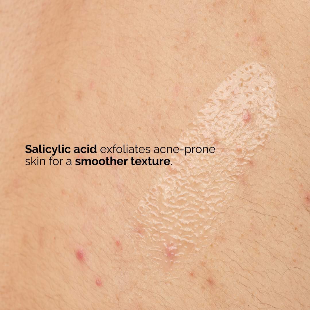 slide 2 of 8, The Ordinary Salicylic Acid 0.5% Body Serum Exfoliating Treatment for Acne 8 oz / 240 ml, 