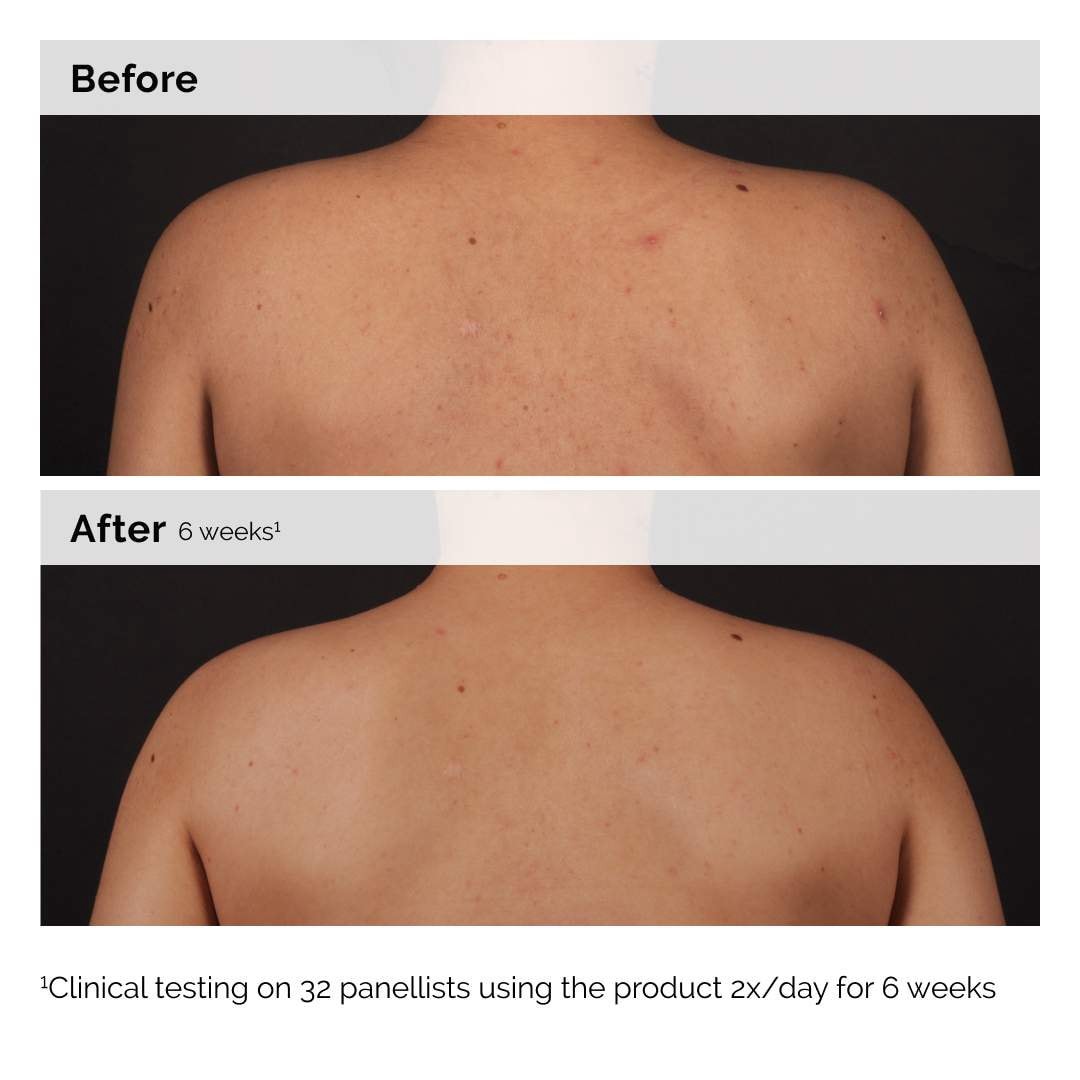 slide 3 of 8, The Ordinary Salicylic Acid 0.5% Body Serum Exfoliating Treatment for Acne 8 oz / 240 ml, 