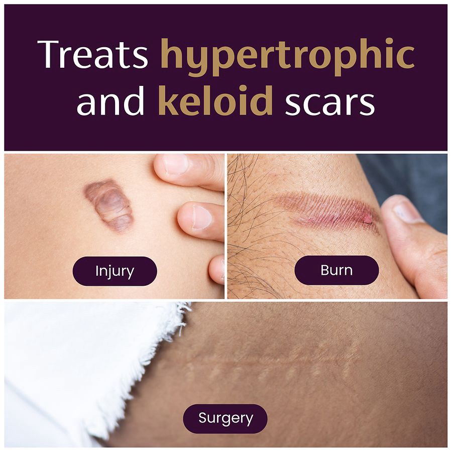 slide 4 of 5, Mederma Small Silicone Scar Sheet 4 ea, 4 ct