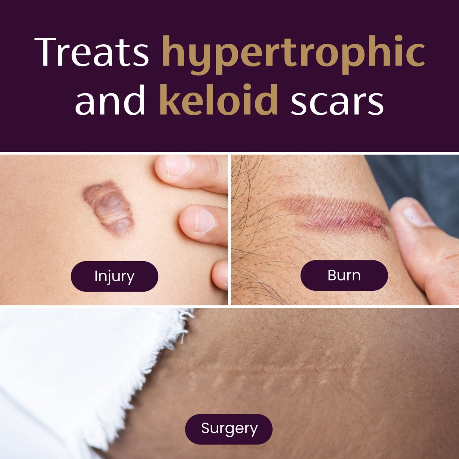 slide 2 of 7, Mederma Small Silicone Scar Sheet 4 ea, 4 ct