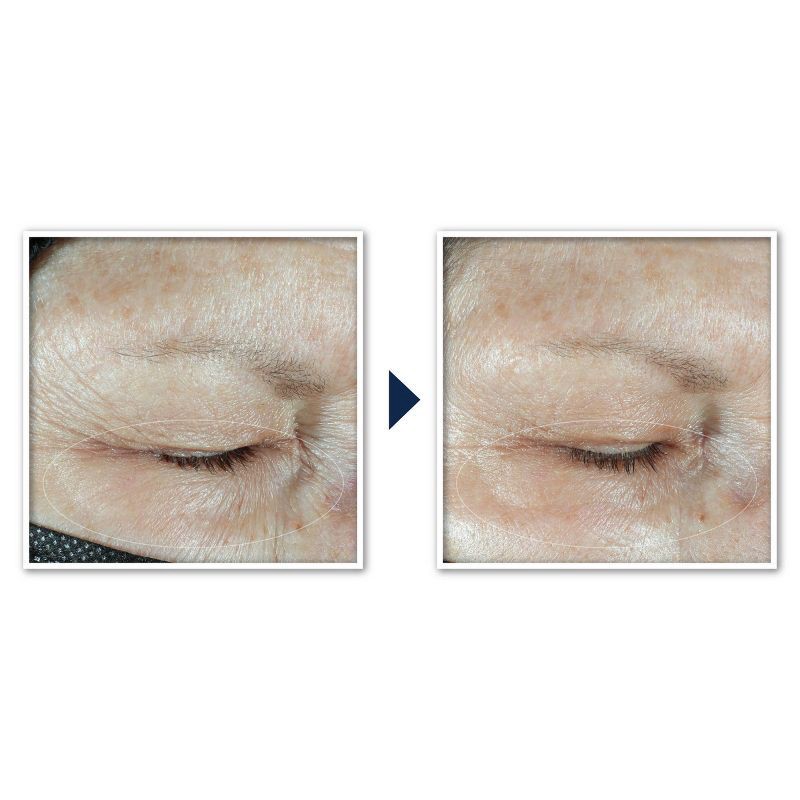 slide 6 of 13, RoC Multi Correxion Hydrate + Plump Eye Cream with Hyaluronic Acid - 0.5oz, 0.5 oz