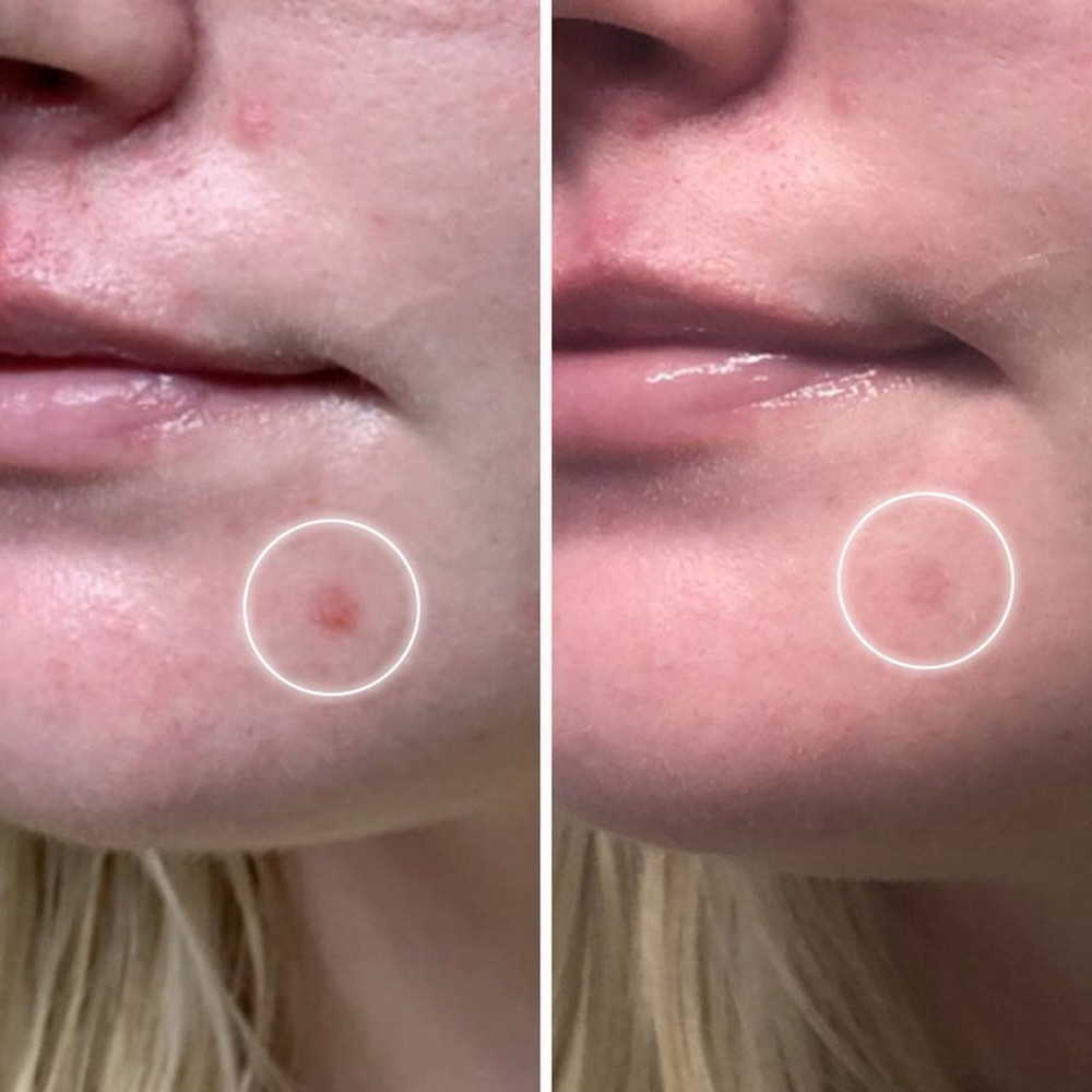 slide 7 of 7, ZitSticka Hyperfade Dark Spot Microdart Patch - 4pk, 4 ct