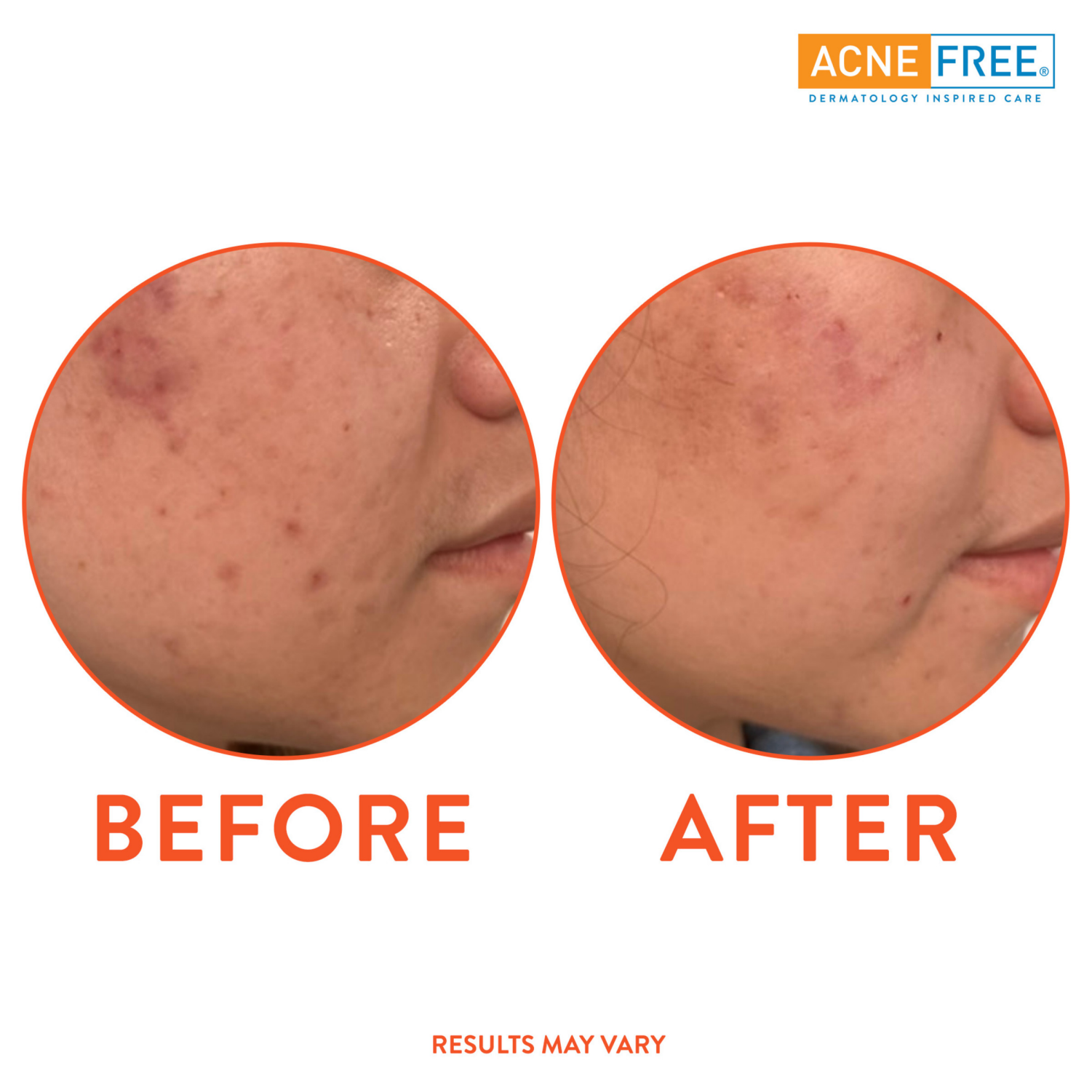 slide 4 of 7, Acne Free 3 Step Kit, 10 oz