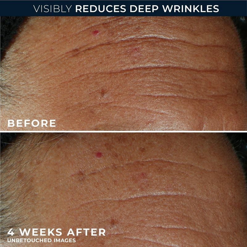 slide 6 of 11, RoC Derm Correxion Fill + Treat Serum - 0.5 fl oz, 0.5 fl oz