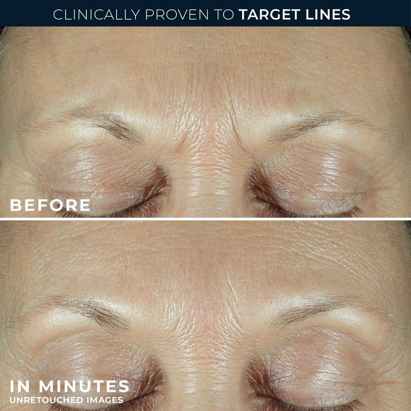 slide 4 of 12, RoC Derm Correxion Fill + Treat Serum - 0.5 fl oz, 0.5 fl oz