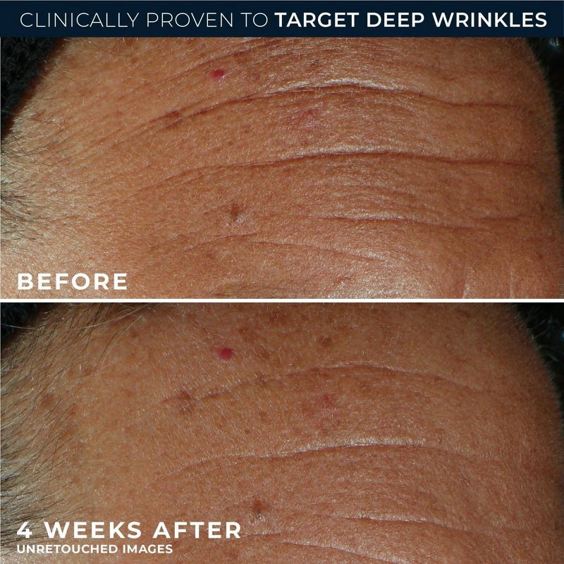 slide 5 of 12, RoC Derm Correxion Fill + Treat Serum - 0.5 fl oz, 0.5 fl oz