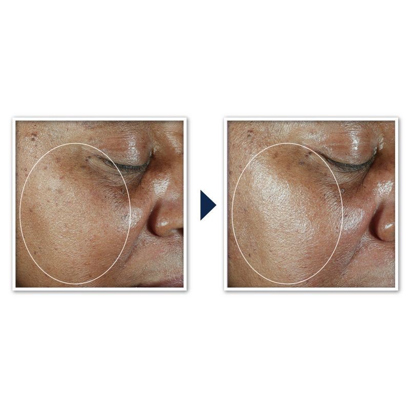 slide 6 of 8, RoC Multi Correxion Even Tone + Lift 5-in-1 Daily Moisturizer - SPF 30 - 1.7oz, 30 ct; 1.7 oz