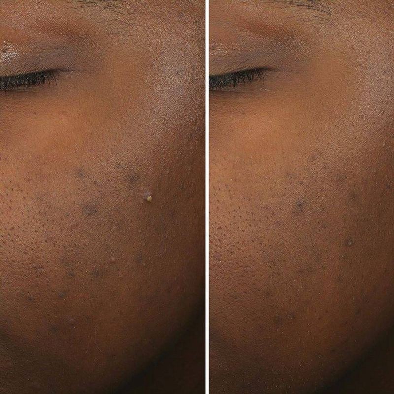 slide 3 of 5, IT Cosmetics Bye Bye Breakout Facial Treatment - 1fl oz - Ulta Beauty, 1 fl oz