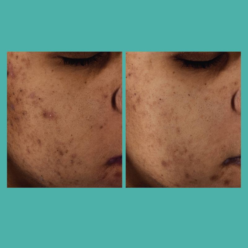 slide 5 of 11, L'Oreal Paris Bright Reveal 12% Niacinamide Dark Spot Serum - 1 floz, 1 ct