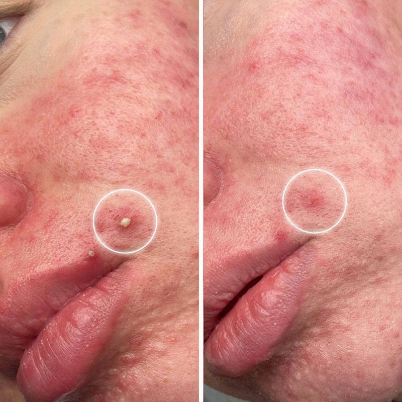 slide 7 of 7, ZitSticka S.O.S Zit Hydrocolloid Acne Pimple Patch Kit - 20ct, 20 ct