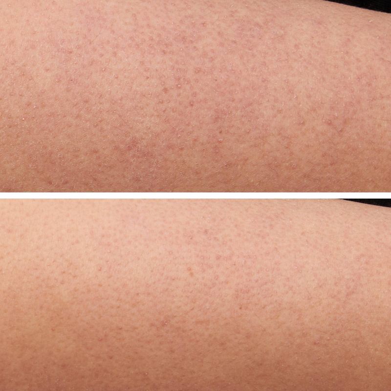 slide 5 of 5, Strivectin KP Care System - 2pc - Ulta Beauty, 2 ct