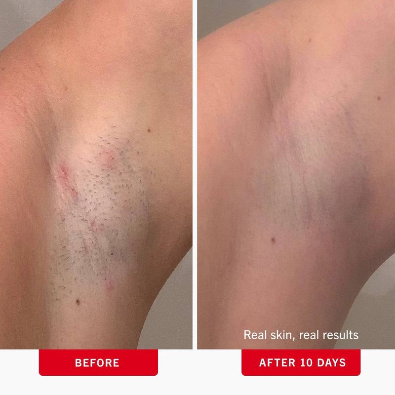 slide 3 of 13, FIRST AID BEAUTY Ingrown Hair Pads, Pre-Shave Gentle Exfoliating Body Pads for Ingrown Hair Prevention - 60ct - Ulta Beauty, 60 ct