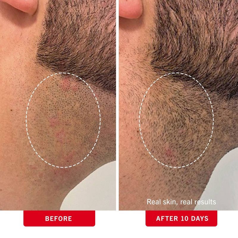 slide 4 of 13, FIRST AID BEAUTY Ingrown Hair Pads, Pre-Shave Gentle Exfoliating Body Pads for Ingrown Hair Prevention - 60ct - Ulta Beauty, 60 ct