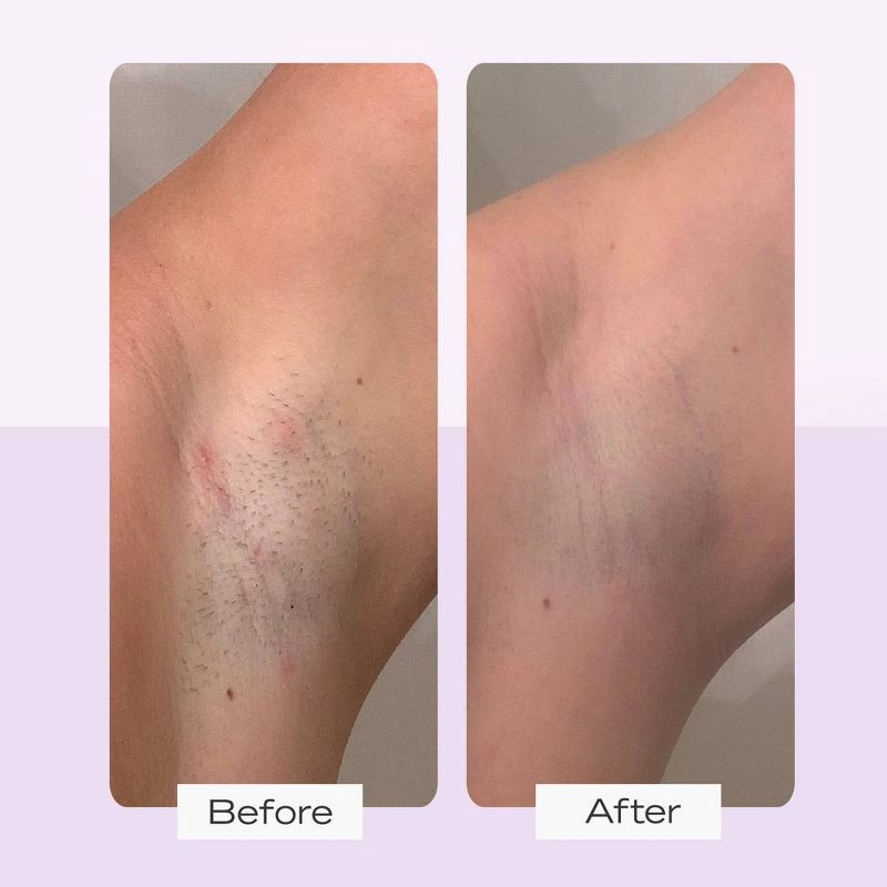 slide 5 of 9, FIRST AID BEAUTY Ingrown Hair Pads - 60ct - Ulta Beauty, 60 ct