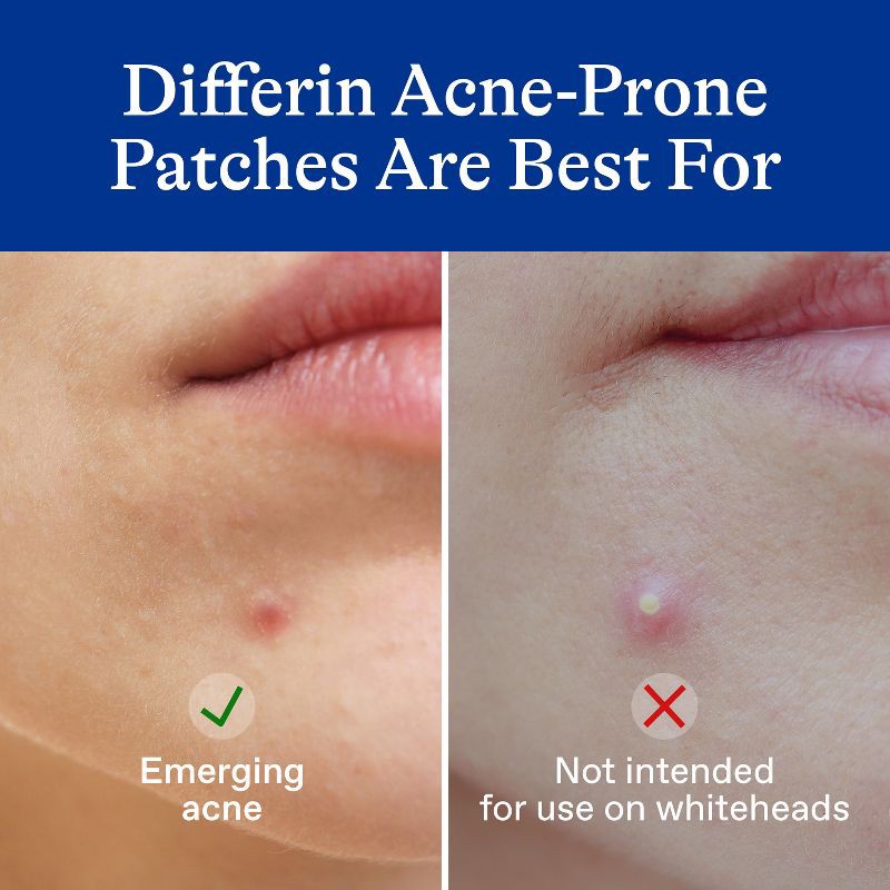 slide 4 of 11, Differin Fast Fix Salicylic Acid Pimple Patches for Emerging Acne - 36ct, 36 ct