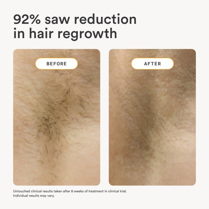 slide 4 of 8, Nood The Flasher 2.0 IPL Permanent Hair Removal, 1 ct