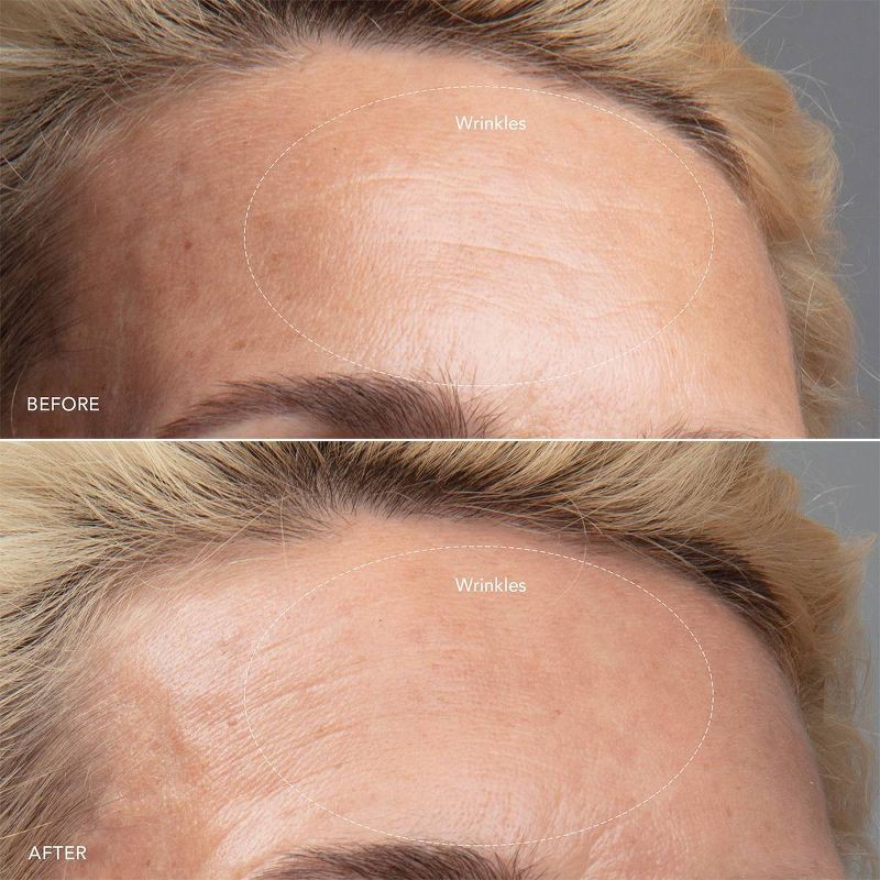 slide 9 of 10, FOREO KIWI derma Skin Tool, 1 ct