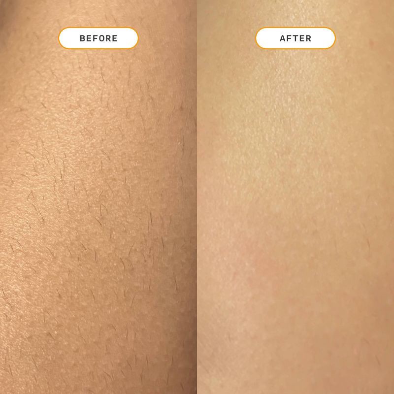 slide 6 of 8, Nood Ingrown Hair Treatment - The Eraser, 1 ct