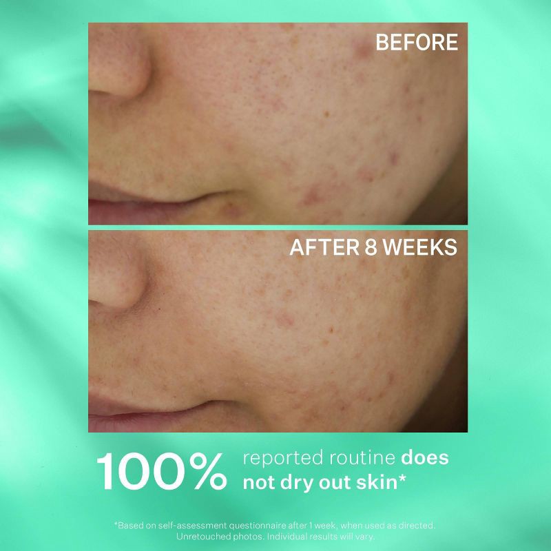 slide 6 of 7, StriVectin Multi-Action Clear Acne Control System - Ulta Beauty, 1 ct