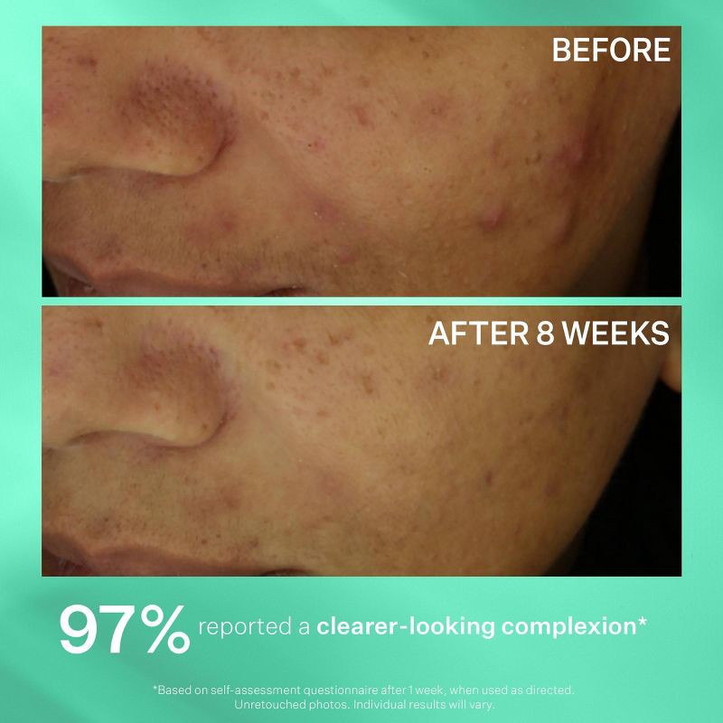 slide 7 of 7, StriVectin Multi-Action Clear Acne Control System - Ulta Beauty, 1 ct