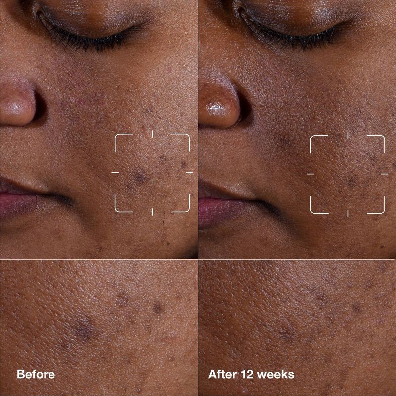 slide 4 of 12, Clinique Even Better Clinical Dark Spot Clearing Serum - 30ml - Ulta Beauty, 30 ml