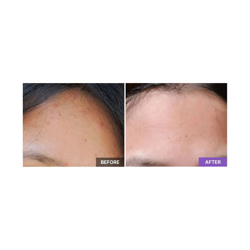 slide 4 of 4, COSRX AHA/BHA Clarifying Treatment Toner - 150ml - Ulta Beauty, 150 ml