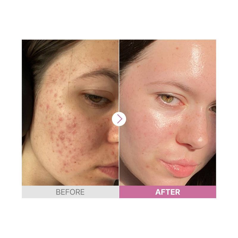 slide 5 of 5, COSRX The Niacinamide 15 Face Serum - 20ml - Ulta Beauty, 20 ml