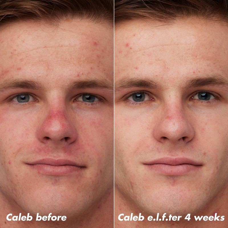 slide 5 of 14, e.l.f. SKIN PLZ Clarify Facial Oil - 2% Salicylic Acid Acne Treatment + Aloe Extract - 1 fl oz, 1 fl oz