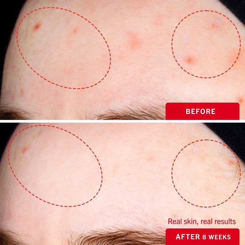 slide 4 of 9, FIRST AID BEAUTY Daily Resurfacing Moisturizer with 2% Niacinamide - 1 fl oz - Ulta Beauty, 1 fl oz