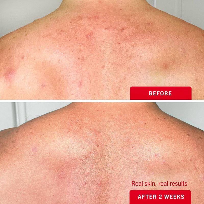 slide 4 of 10, FIRST AID BEAUTY Body Acne Clearing Mist with 2% Salicylic Acid - 3oz - Ulta Beauty, 3 oz