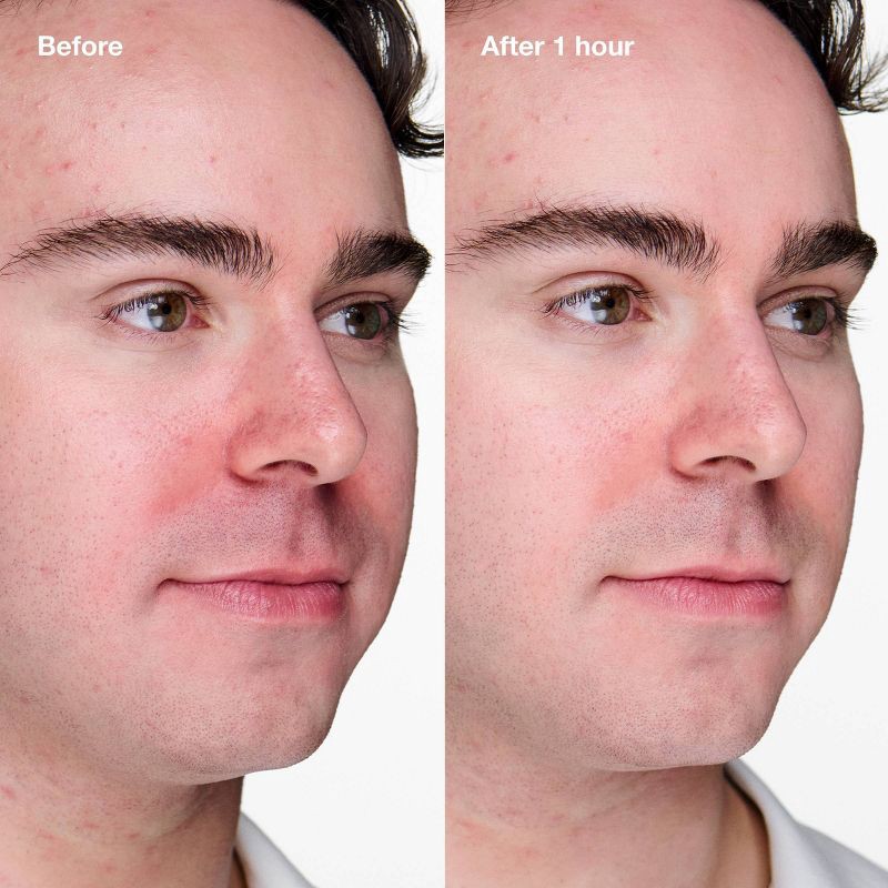 slide 4 of 9, Clinique Acne Solutions Clinical Advanced Clearing Gel - 0.34 fl oz - Ulta Beauty, 0.34 fl oz