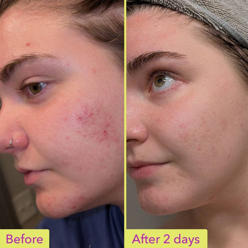 slide 3 of 6, Good Molecules 10% Azelaic Acid Face Treatment - 30ml, 30 ml